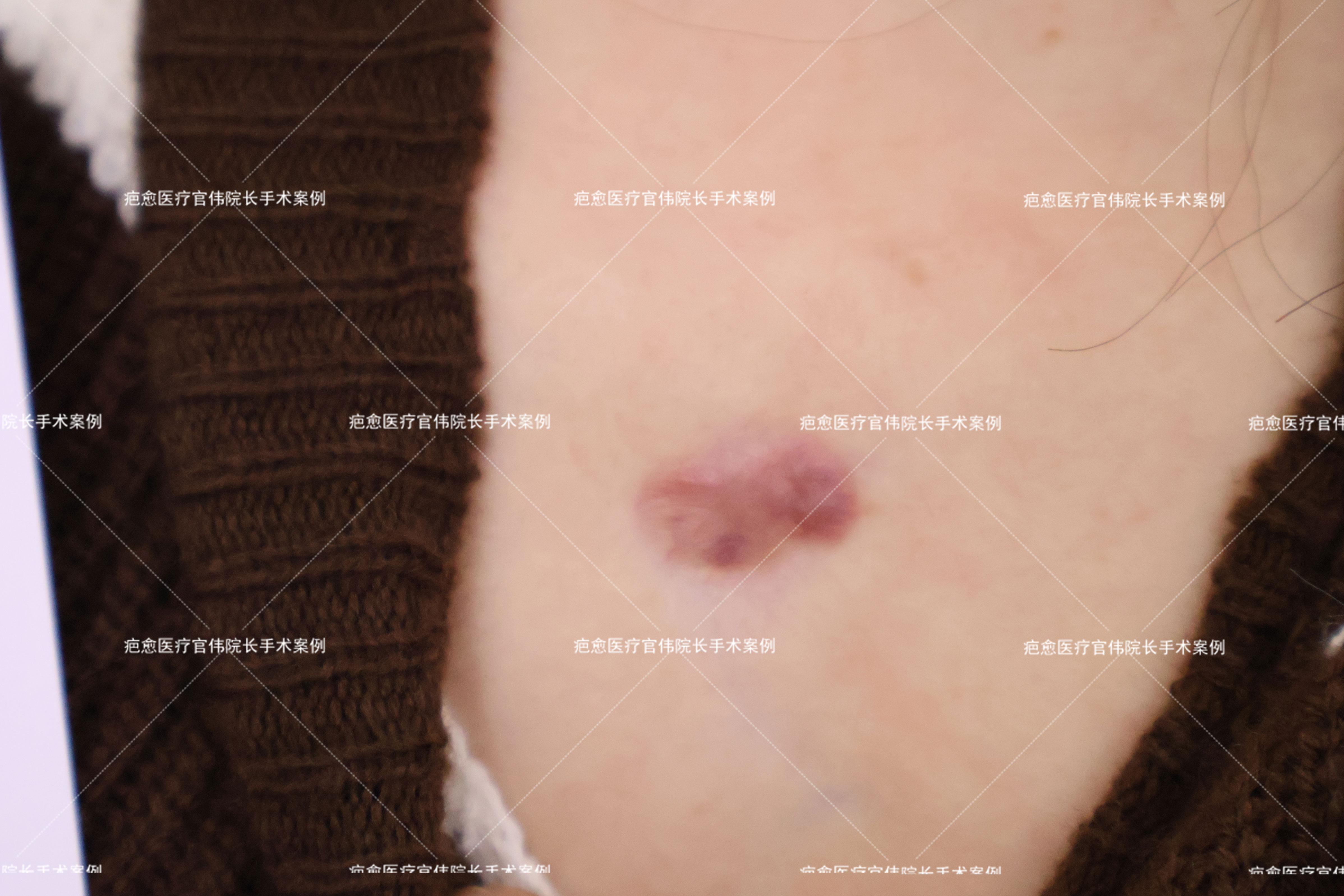 <b>收藏！预防瘢痕疙瘩新生的三个小妙招</b>