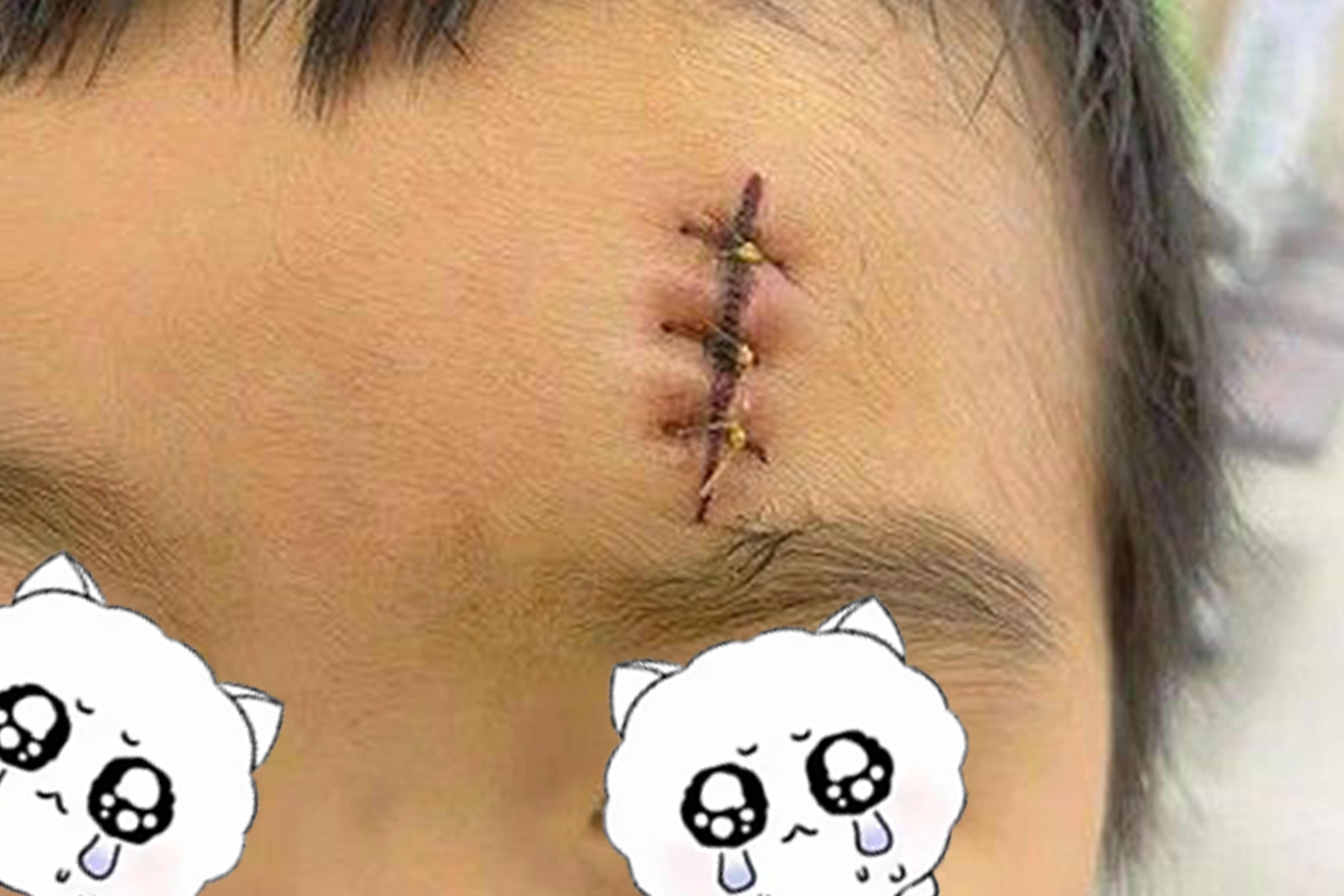 家长必看！为什么青少年的疤痕需尽早治疗？