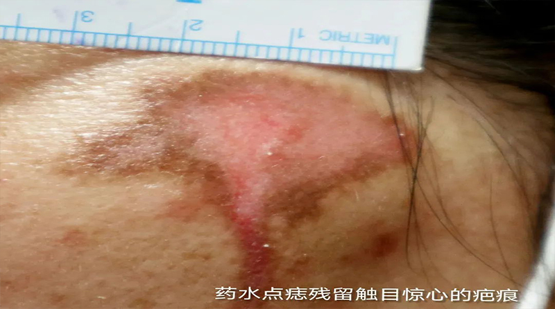 点痣后为什么会留下疤痕？可以自行消退吗？