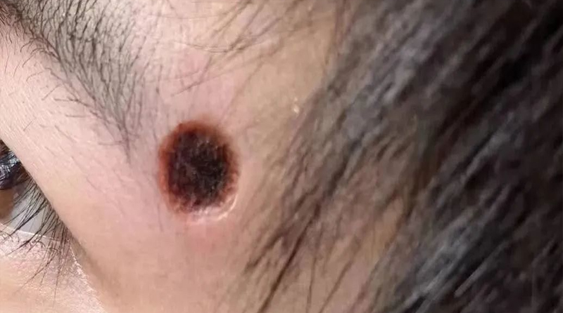 疤痕怎么去除？