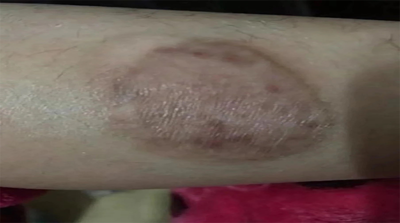 点阵激光：瘢痕修复的神奇之光
