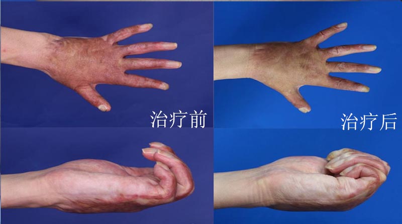 科普 | 烧伤后瘢痕的综合防治攻略
