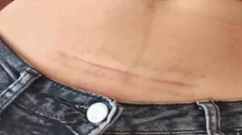 剖腹产疤痕增生原因，该怎么应对？