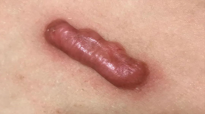 疤痕疙瘩为何会反复溃烂？