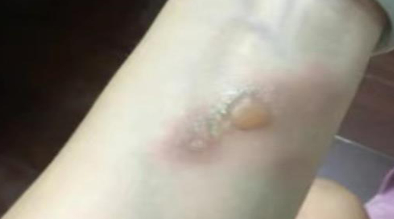 烫伤后出现水泡的，该怎么处理？