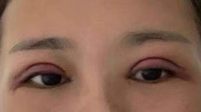割双眼皮留下丑陋疤痕？怎么办？