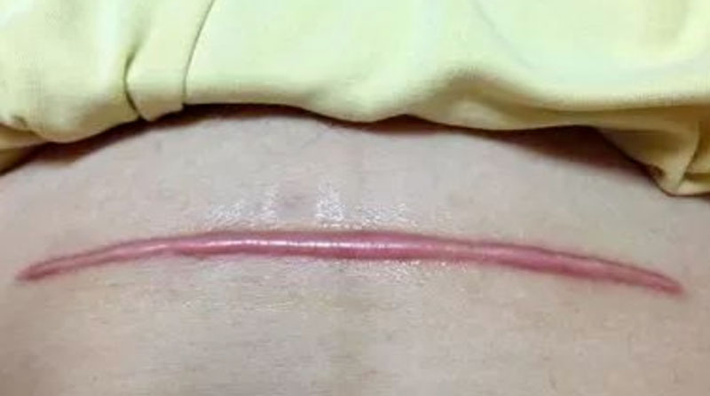 宝妈必看 | 妈妈剖腹产留下的疤痕该怎么抚平?