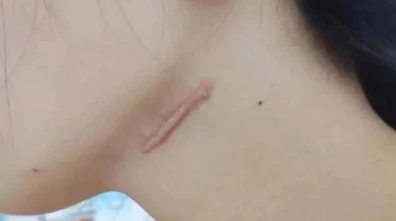瘢痕疙瘩的发病原因探析