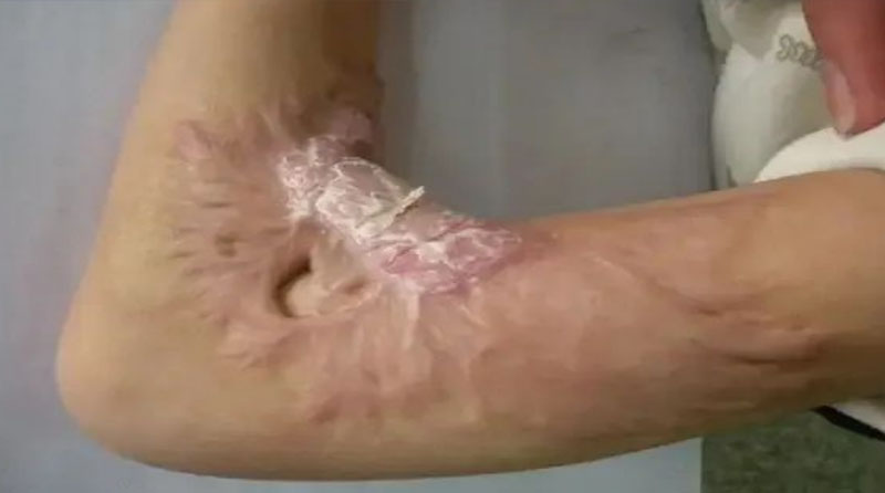 烫伤后疤痕瘙痒增生的缓解与预防策略