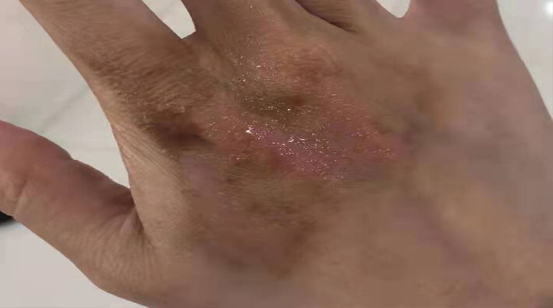 热水烫伤后，怎样做才能不留疤少留疤?