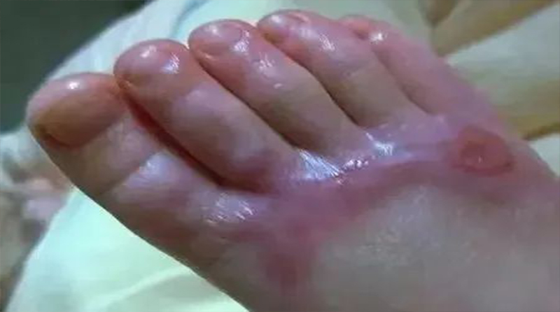 烧伤后涂抹牙膏？你可能需要知道的真相！