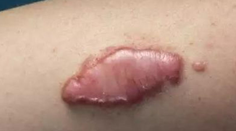 ＂疤痕内部增生的原因、症状、治疗与预防全解