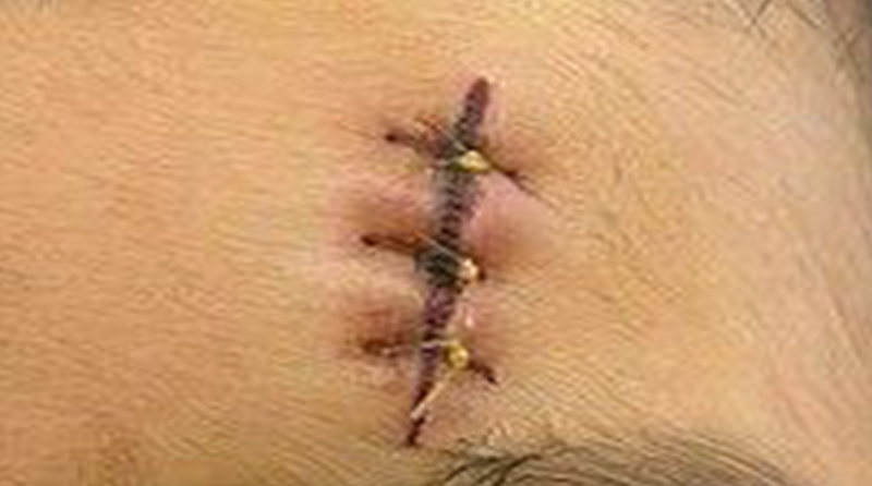 缝针疤痕能否恢复到肉眼看不到？