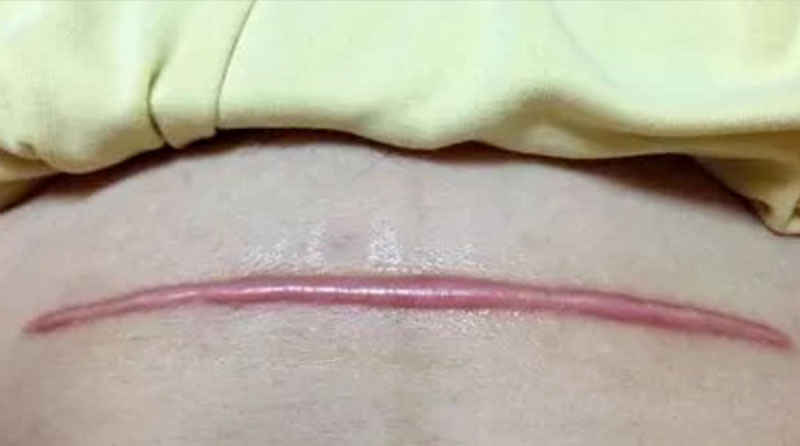 剖腹产后的困扰：疤痕增生的原因、症状与防治