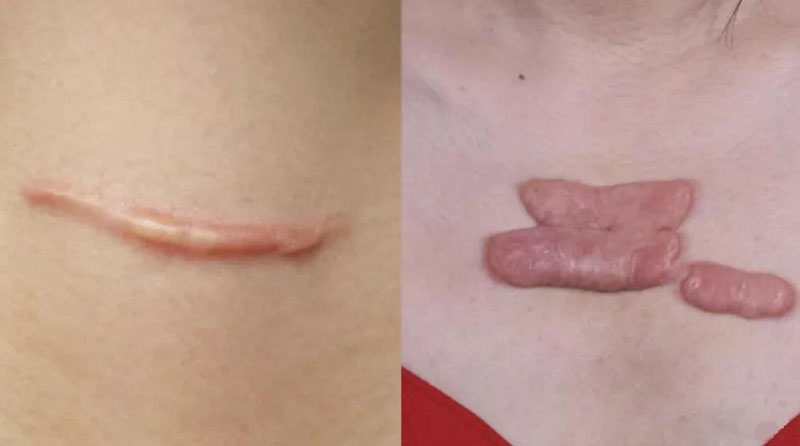 【微科普】瘢痕增生不可怕，就怕治疗不趁早