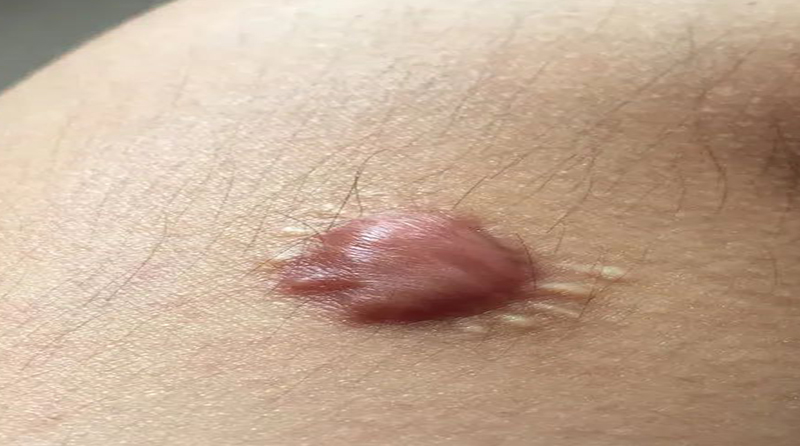 疤痕疙瘩发紧还发疼,可能是炎症反应吗？