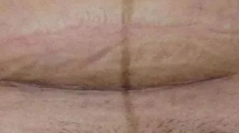 剖腹产疤痕增生修复