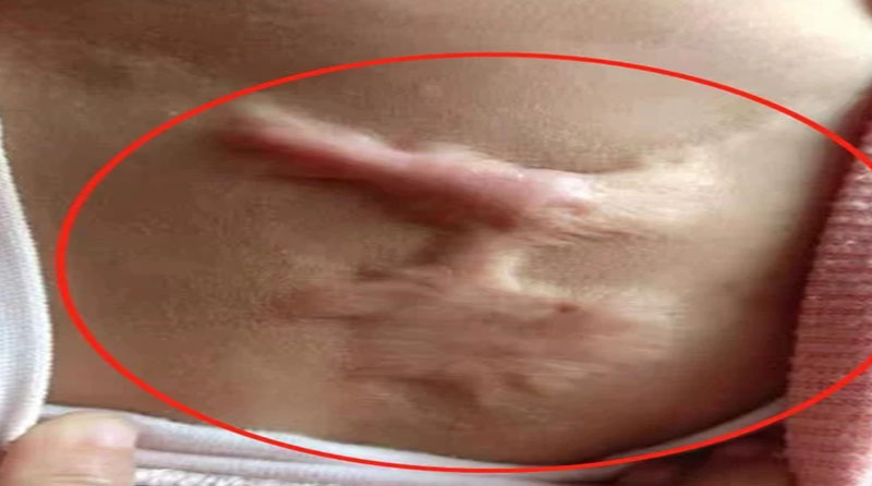 为什么疤痕疙瘩老是复发?如何防止疤痕复发?