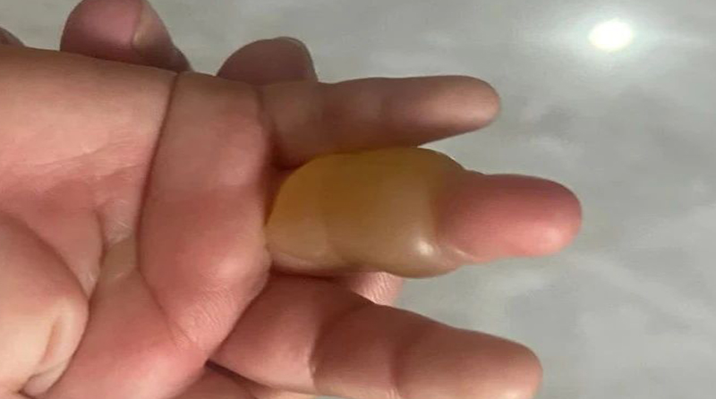 烧烫伤疤痕是如何形成的