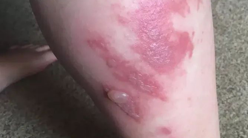 烧伤后是否必然会形成瘢痕？