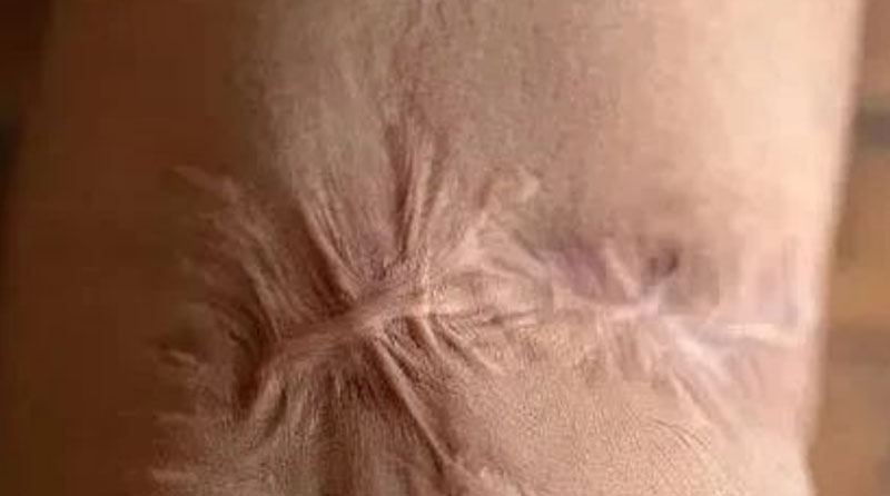 告别陈旧疤痕，重拾肌肤自信——十年疤痕去除