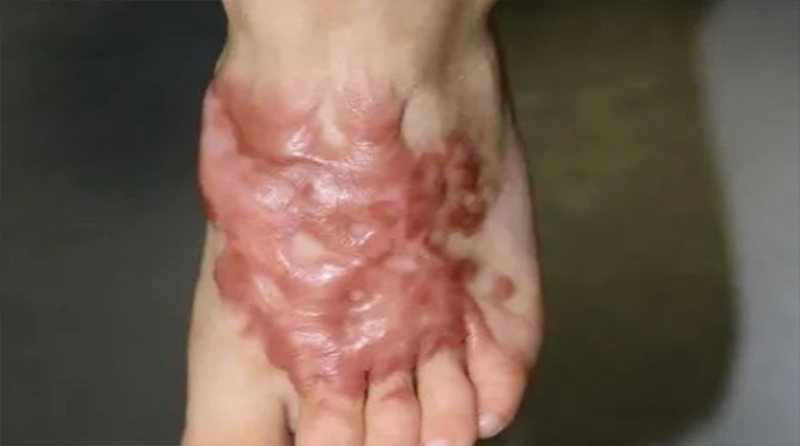 一觉醒来掉了一块皮！真的别再小瞧低温