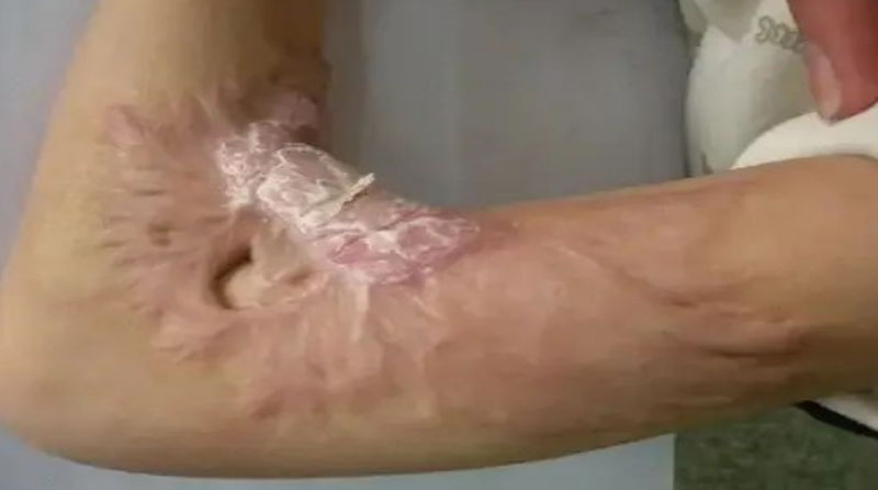 烫伤后大面积疤痕粘连怎么办？科学应对与心理